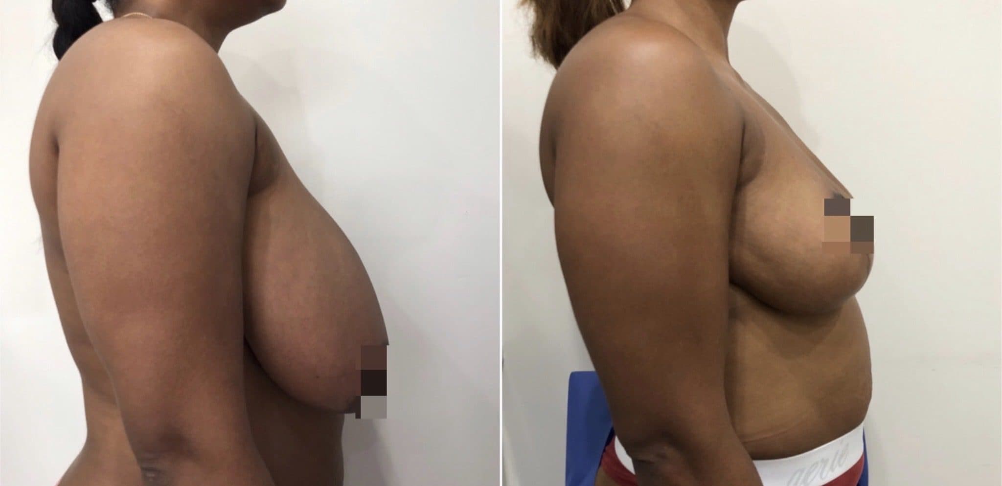 Before and after breast surgery by Dr. Dana Khuthaila, plastic surgeon in New York City — patient 13