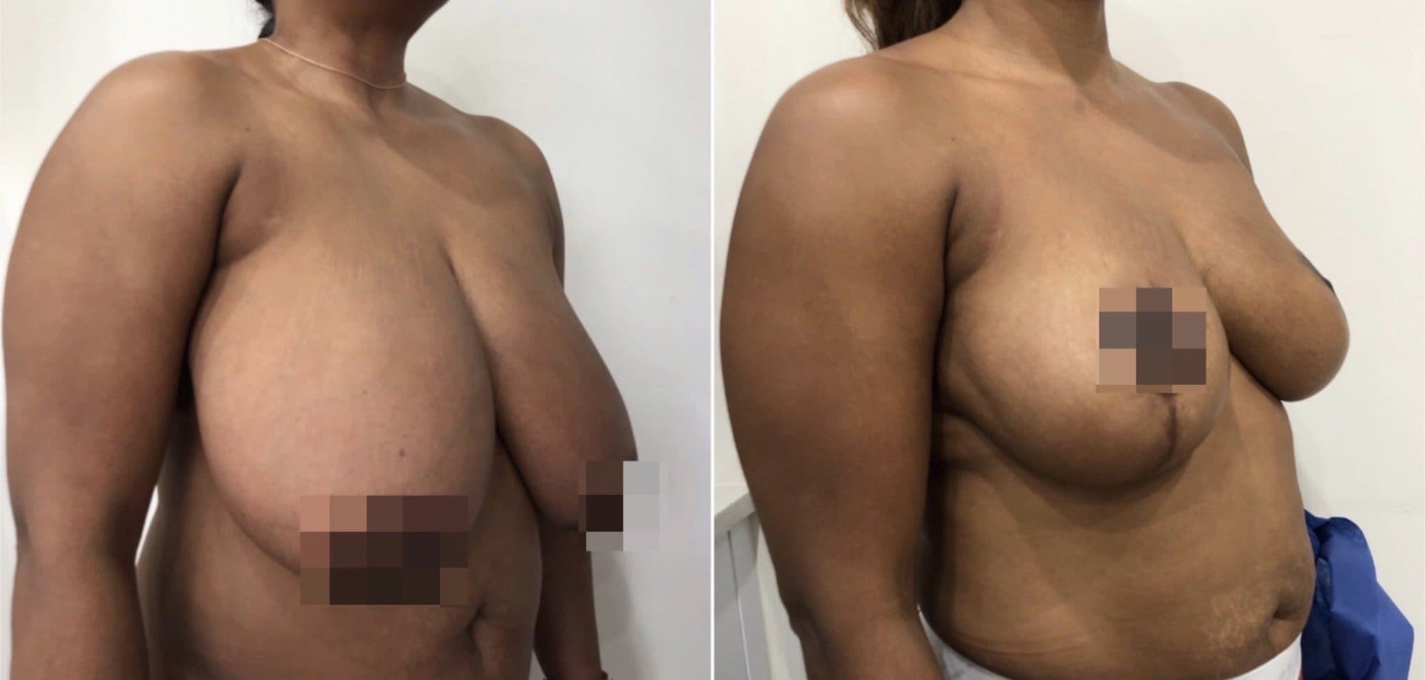 Before and after breast surgery by Dr. Dana Khuthaila, plastic surgeon in New York City — patient 14