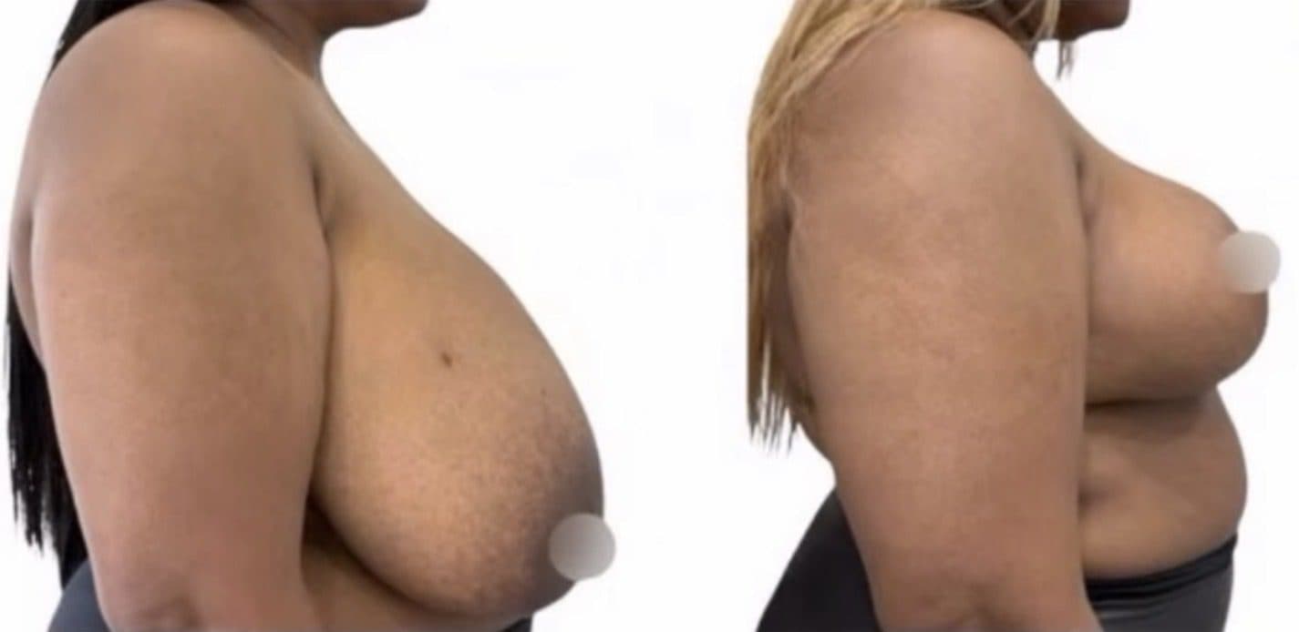 Before and after breast surgery by Dr. Dana Khuthaila, plastic surgeon in New York City — patient 12