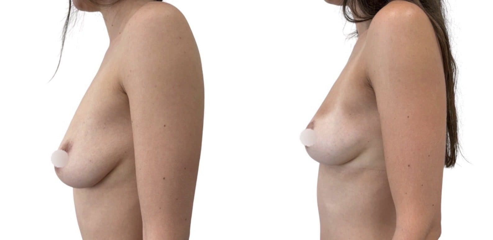 Before and after breast surgery by Dr. Dana Khuthaila, plastic surgeon in New York City — patient 74