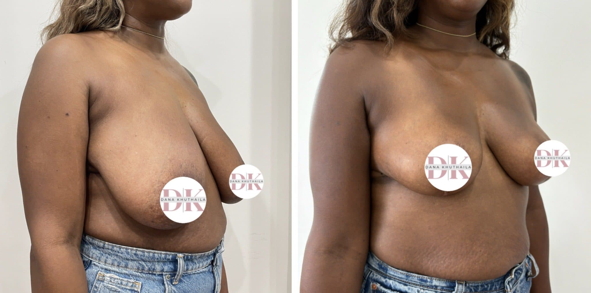 Before and after breast surgery by Dr. Dana Khuthaila, plastic surgeon in New York City — patient 4