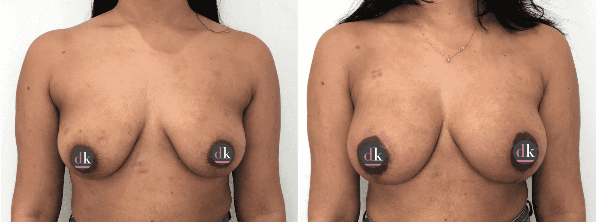 Before and after breast surgery by Dr. Dana Khuthaila, plastic surgeon in New York City — patient 35