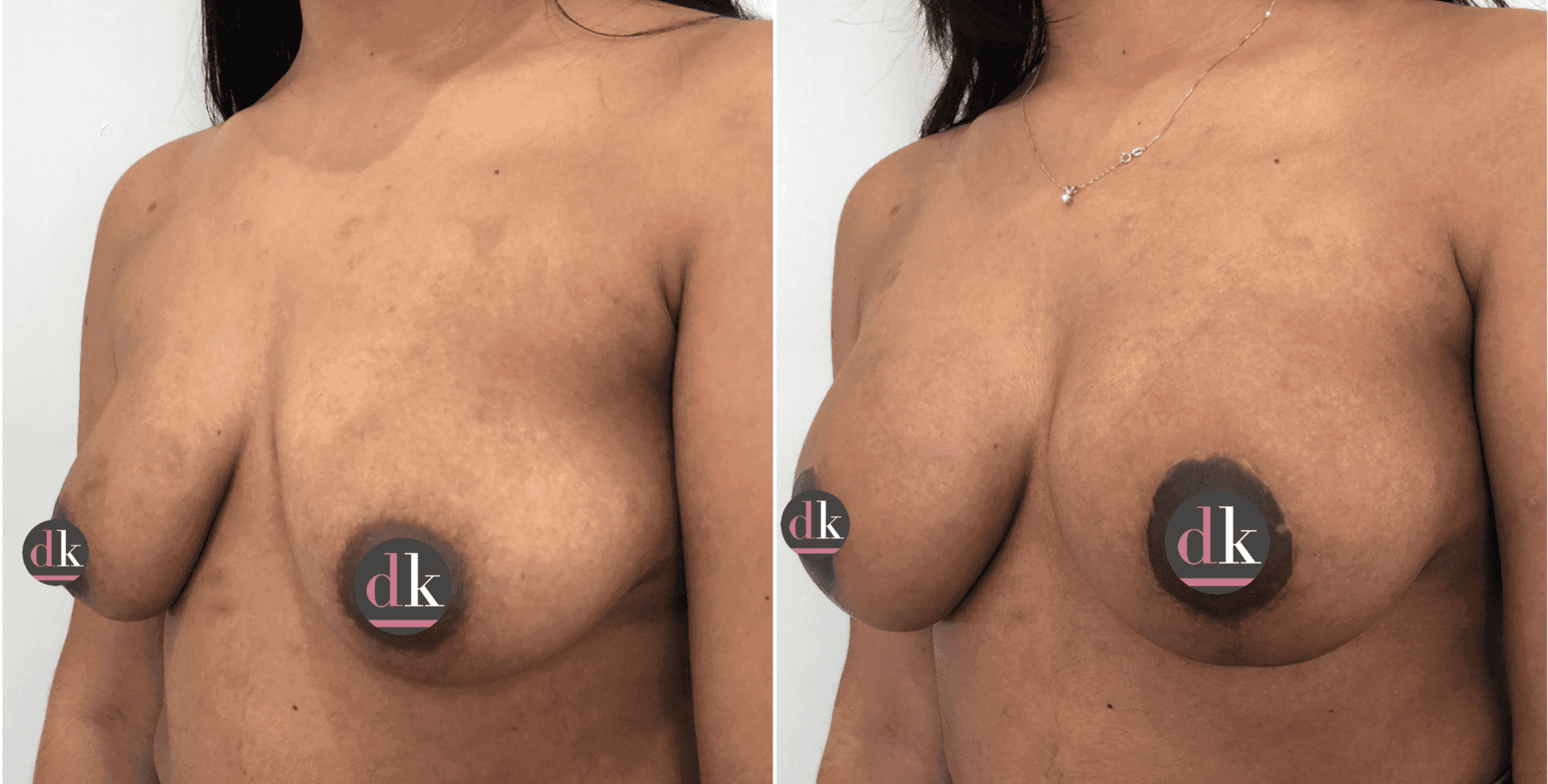 Before and after breast surgery by Dr. Dana Khuthaila, plastic surgeon in New York City — patient 32