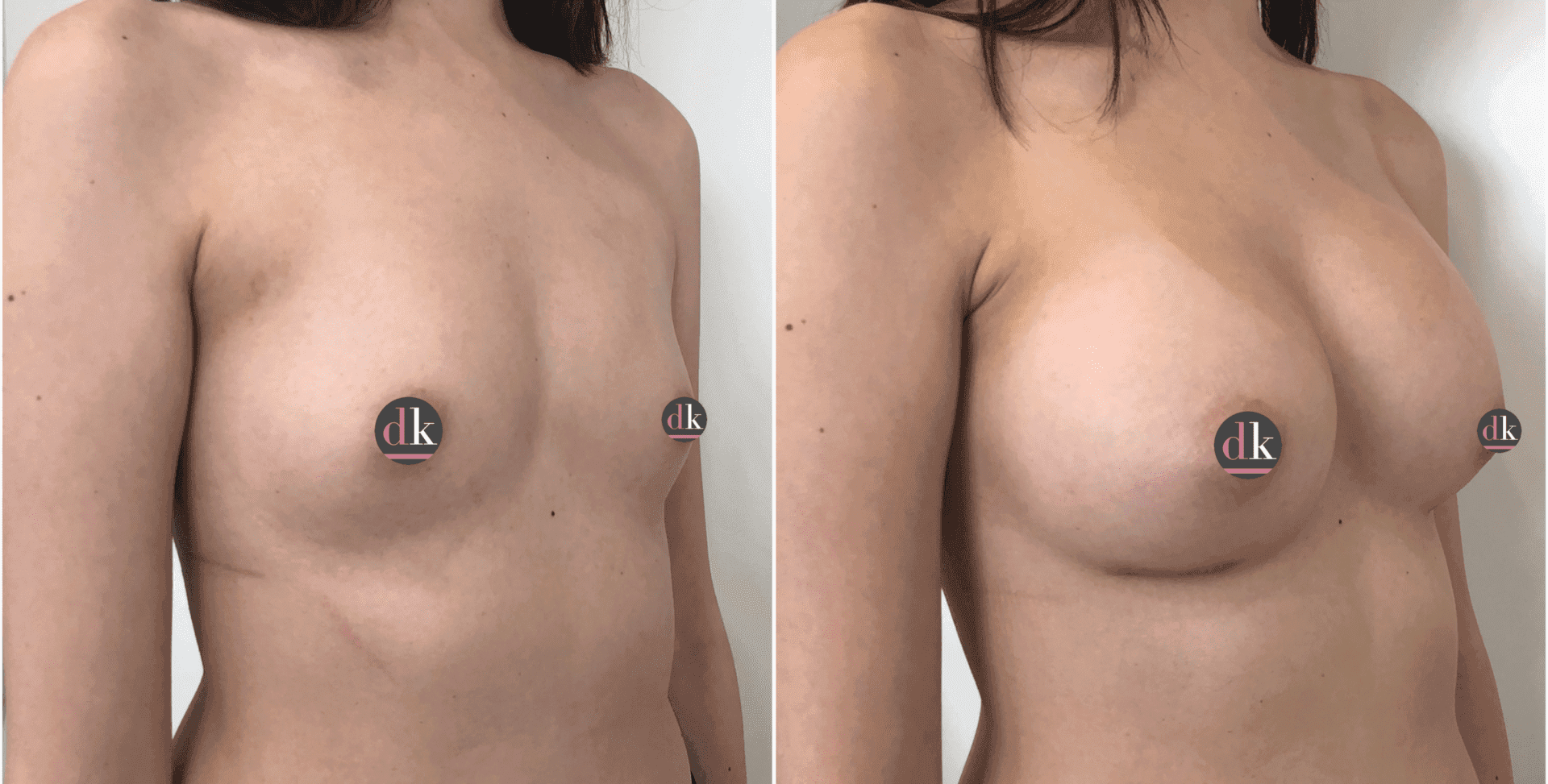 Before and after breast surgery by Dr. Dana Khuthaila, plastic surgeon in New York City — patient 48