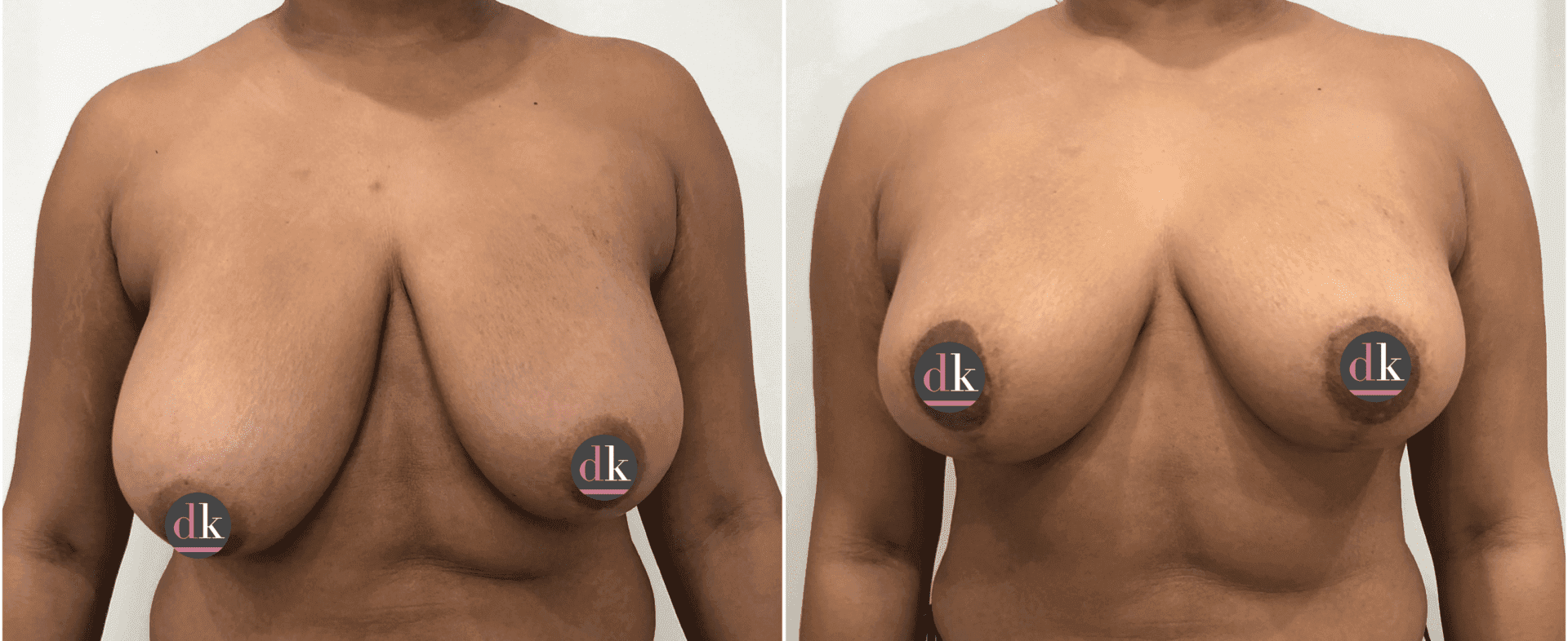 Before and after breast surgery by Dr. Dana Khuthaila, plastic surgeon in New York City — patient 10