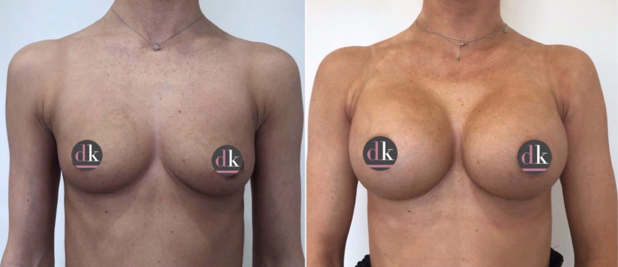 Before and after breast surgery by Dr. Dana Khuthaila, plastic surgeon in New York City — patient 53