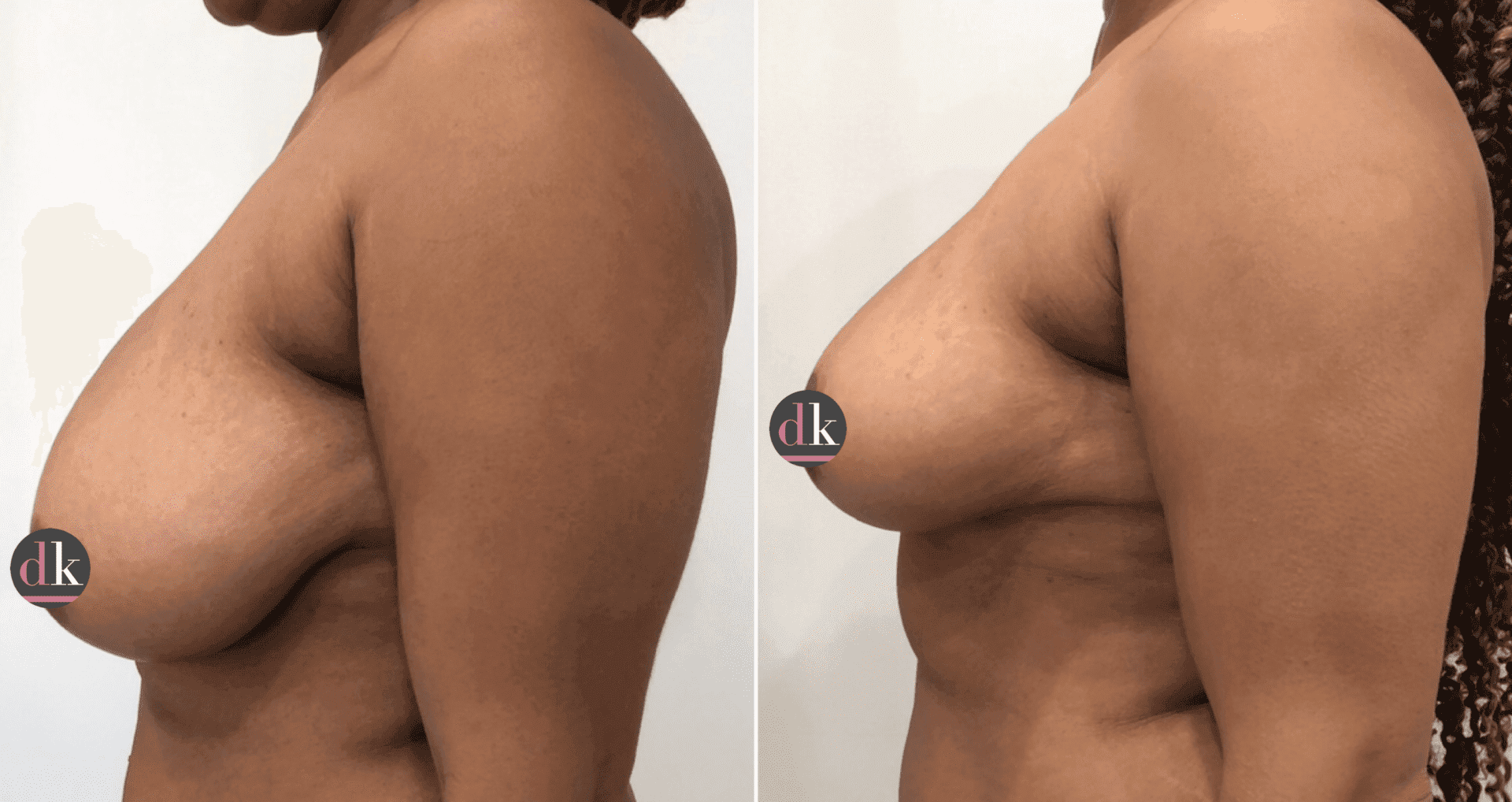 Before and after breast surgery by Dr. Dana Khuthaila, plastic surgeon in New York City — patient 5