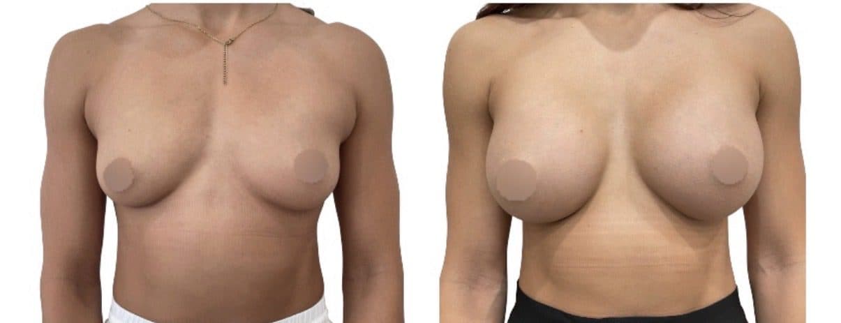 Before and after breast surgery by Dr. Dana Khuthaila, plastic surgeon in New York City — patient 90