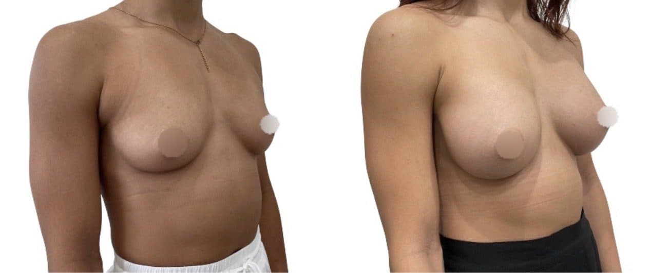 Before and after breast surgery by Dr. Dana Khuthaila, plastic surgeon in New York City — patient 91