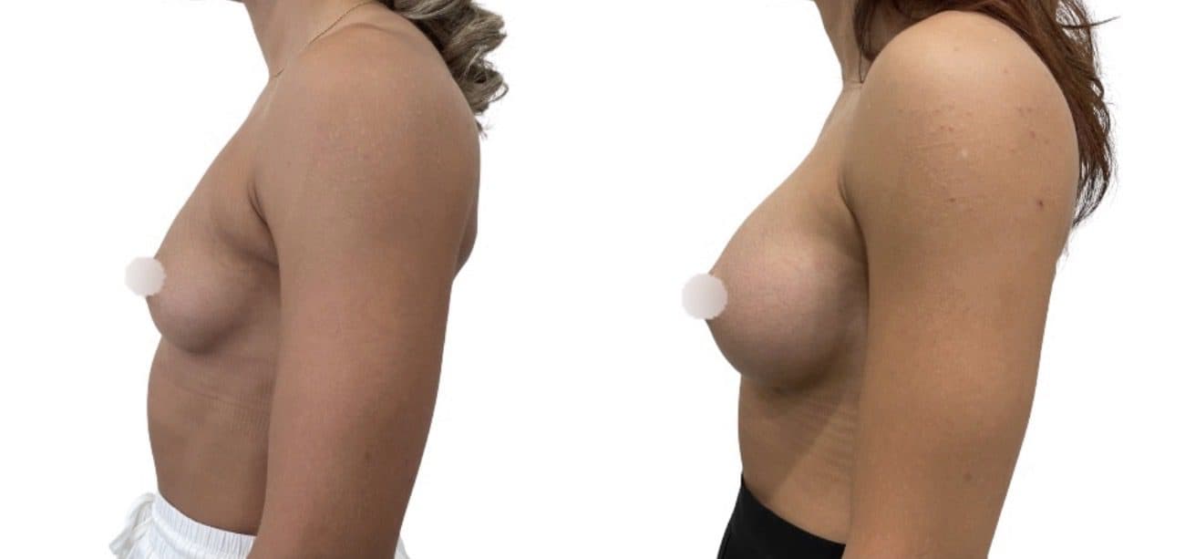 Before and after breast surgery by Dr. Dana Khuthaila, plastic surgeon in New York City — patient 92