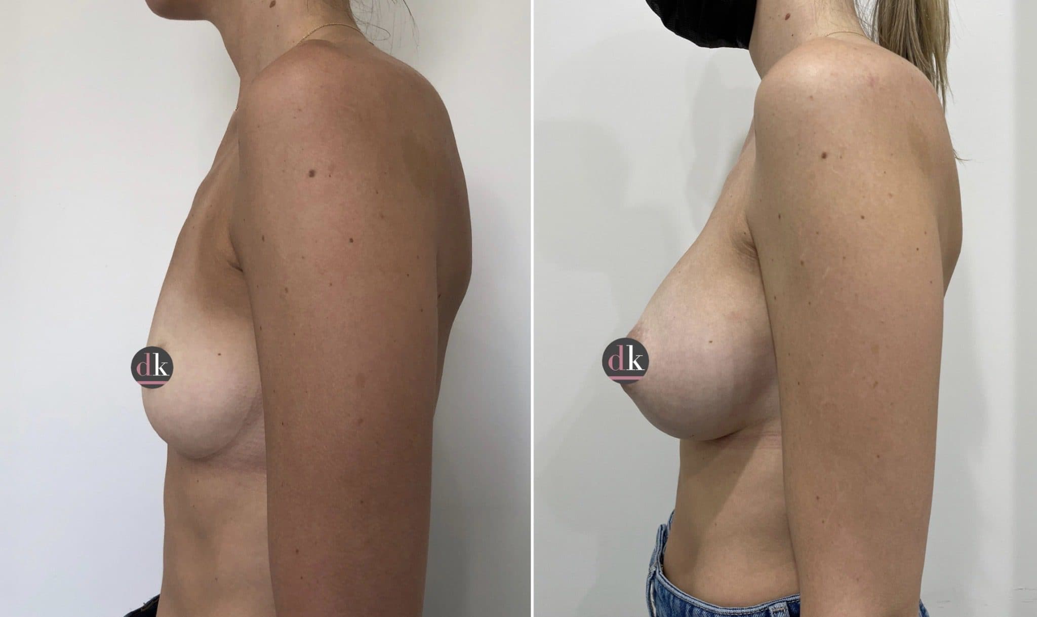 Before and after breast surgery by Dr. Dana Khuthaila, plastic surgeon in New York City — patient 79
