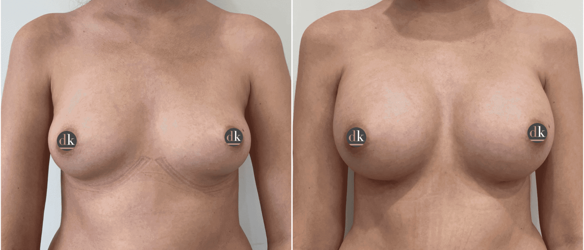 Before and after breast surgery by Dr. Dana Khuthaila, plastic surgeon in New York City — patient 50