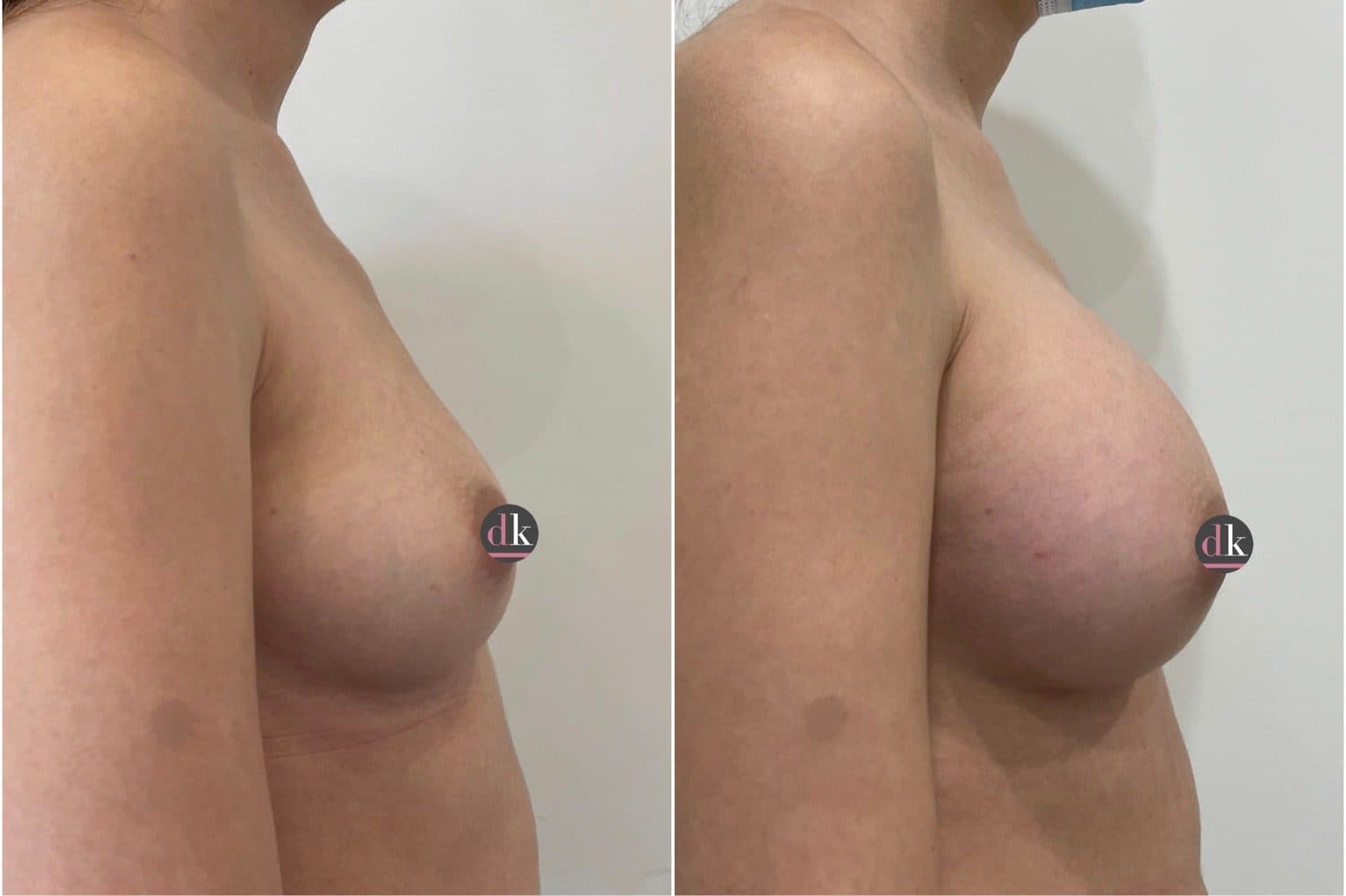 Before and after breast surgery by Dr. Dana Khuthaila, plastic surgeon in New York City — patient 29