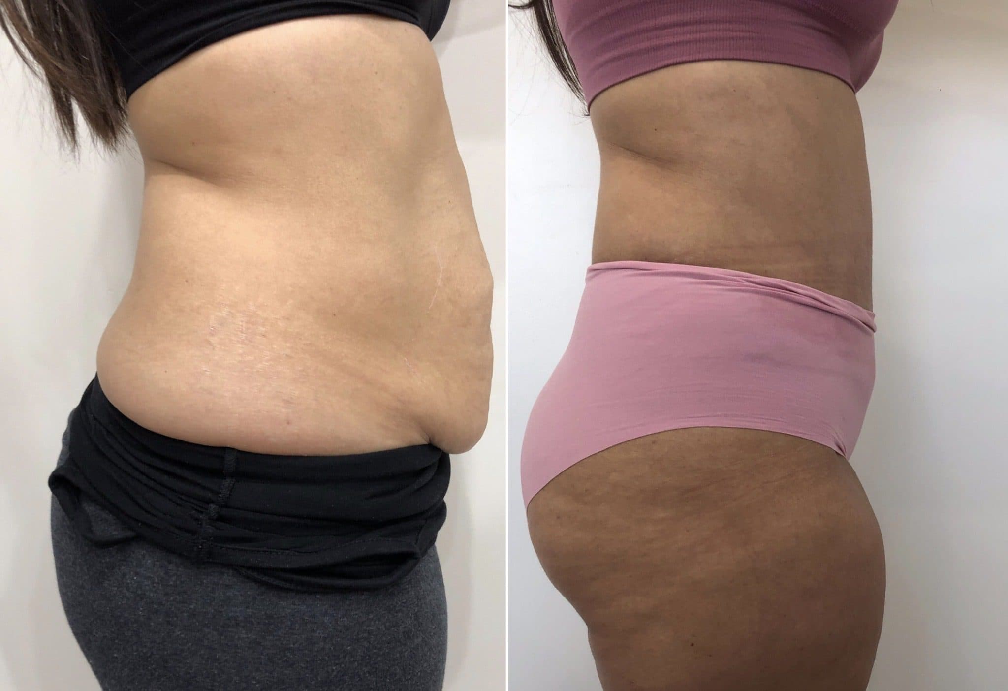 Before and after body surgery by Dr. Dana Khuthaila, plastic surgeon in New York City — patient 34