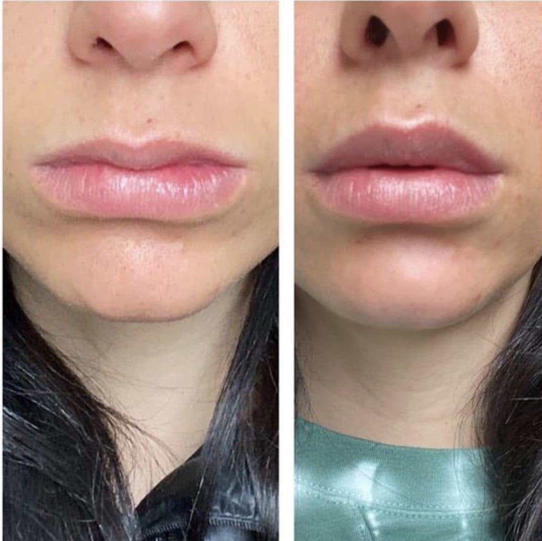 Before and after injectables surgery by Dr. Dana Khuthaila, plastic surgeon in New York City — patient 7