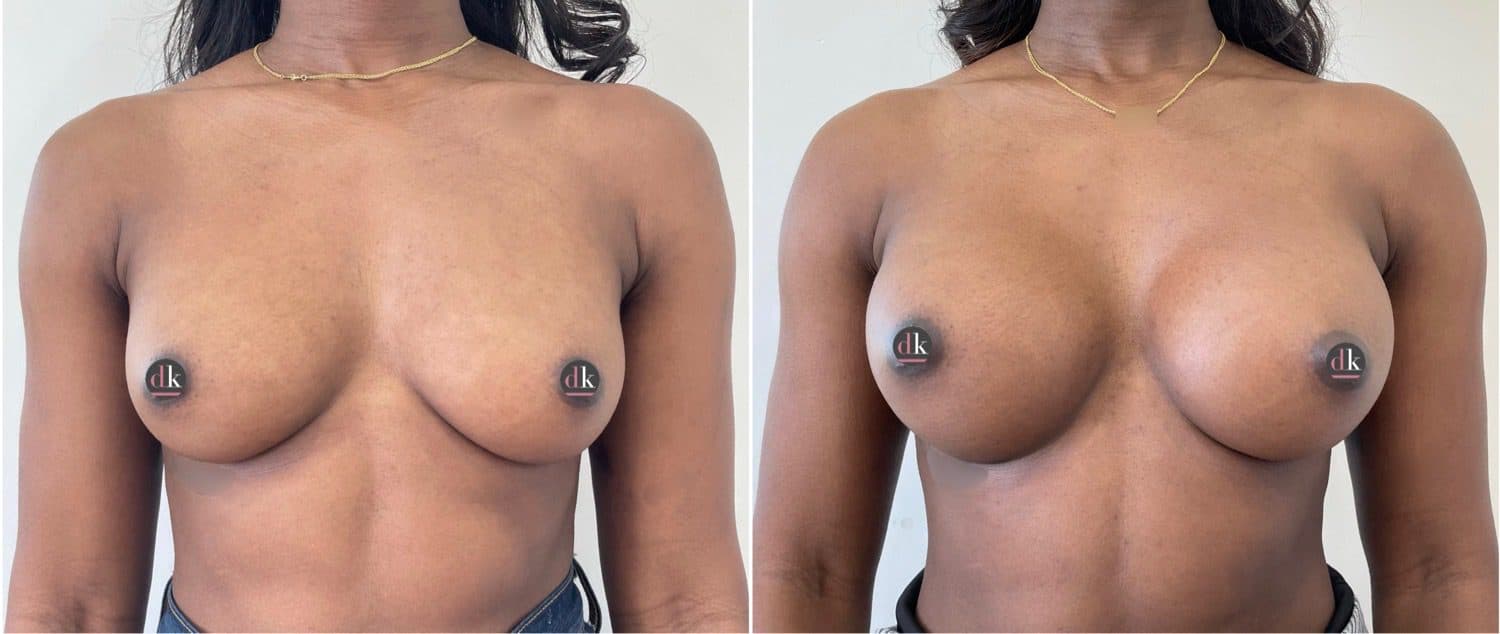Before and after breast surgery by Dr. Dana Khuthaila, plastic surgeon in New York City — patient 45