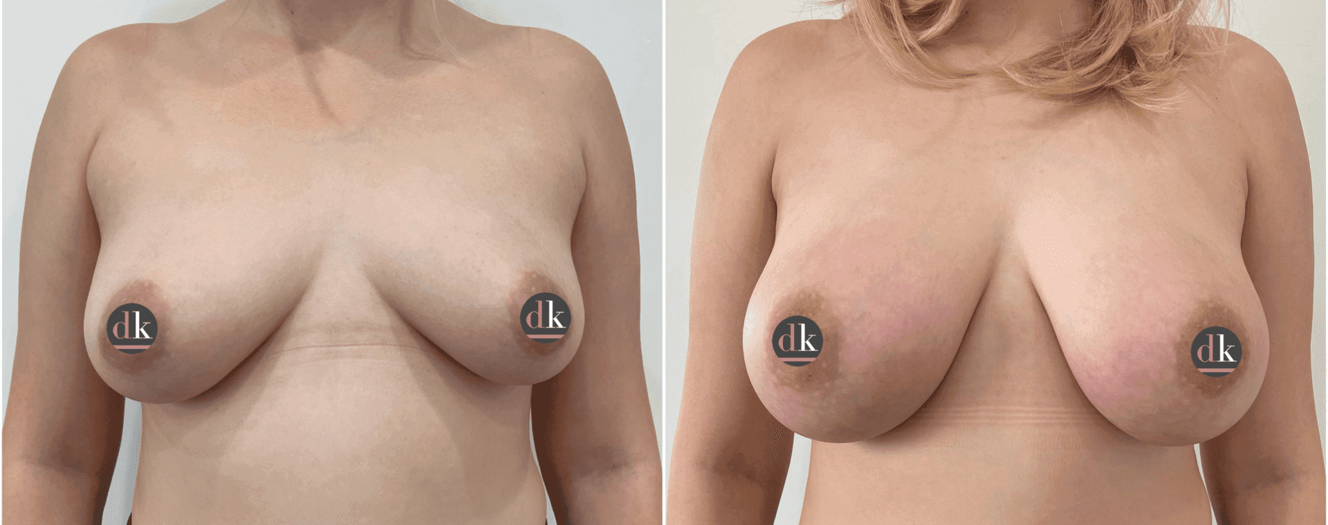 Before and after breast surgery by Dr. Dana Khuthaila, plastic surgeon in New York City — patient 30