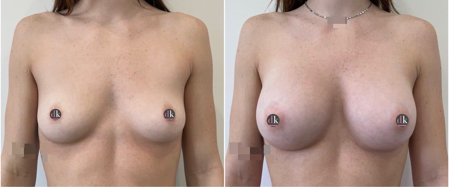 Before and after breast surgery by Dr. Dana Khuthaila, plastic surgeon in New York City — patient 47