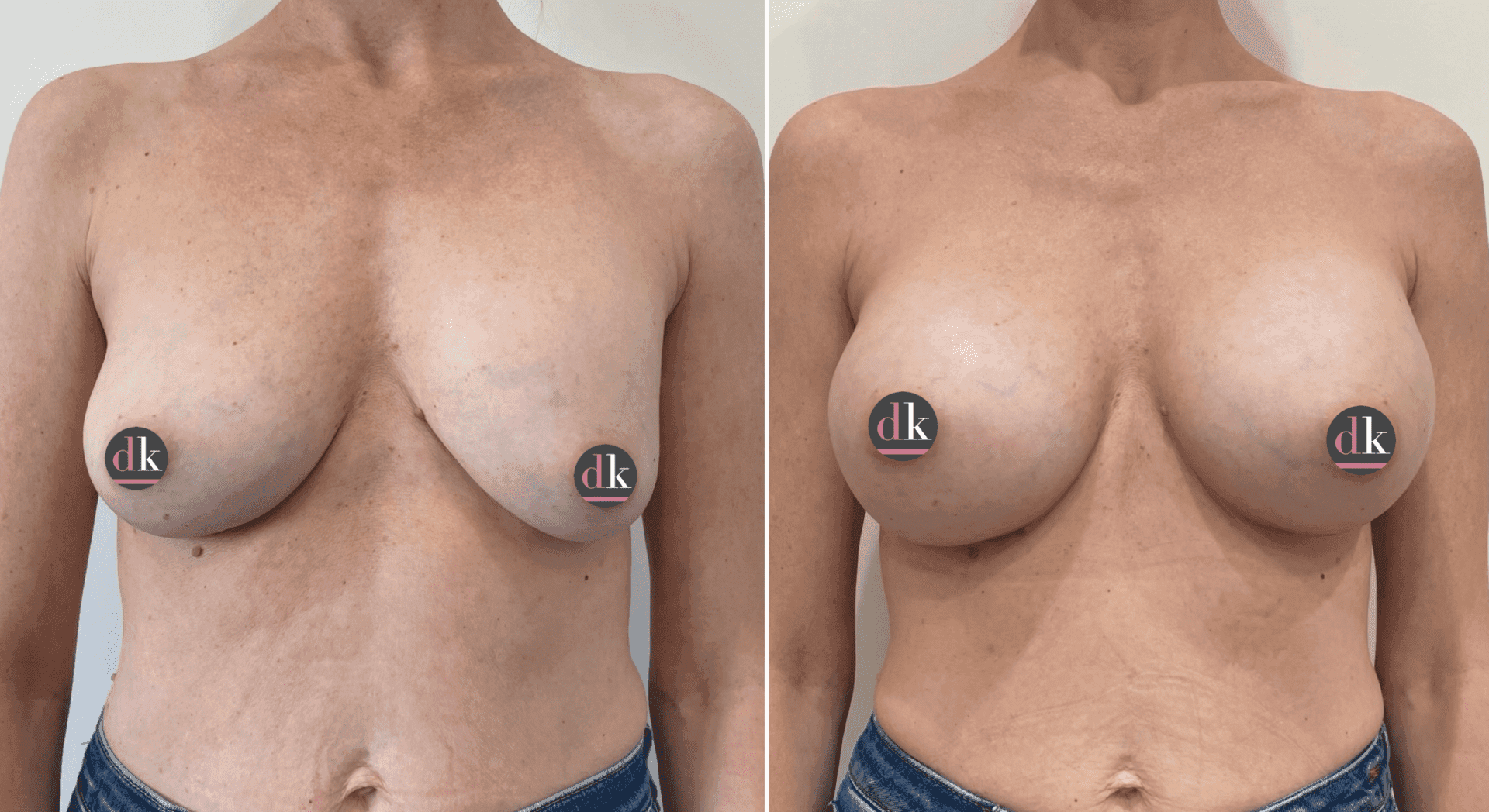 Before and after breast surgery by Dr. Dana Khuthaila, plastic surgeon in New York City — patient 26