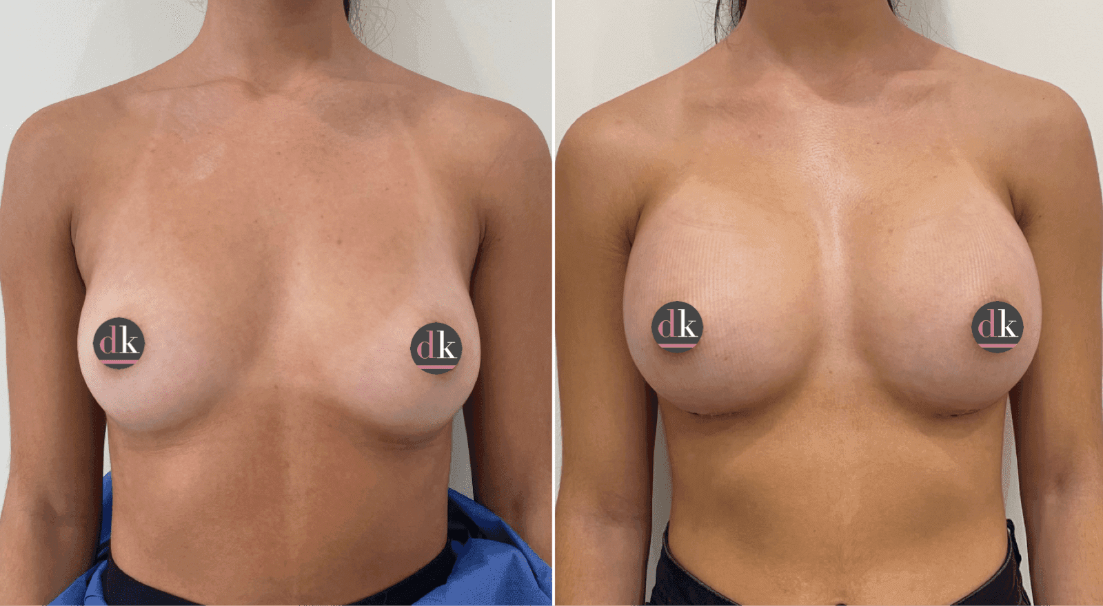 Before and after breast surgery by Dr. Dana Khuthaila, plastic surgeon in New York City — patient 24