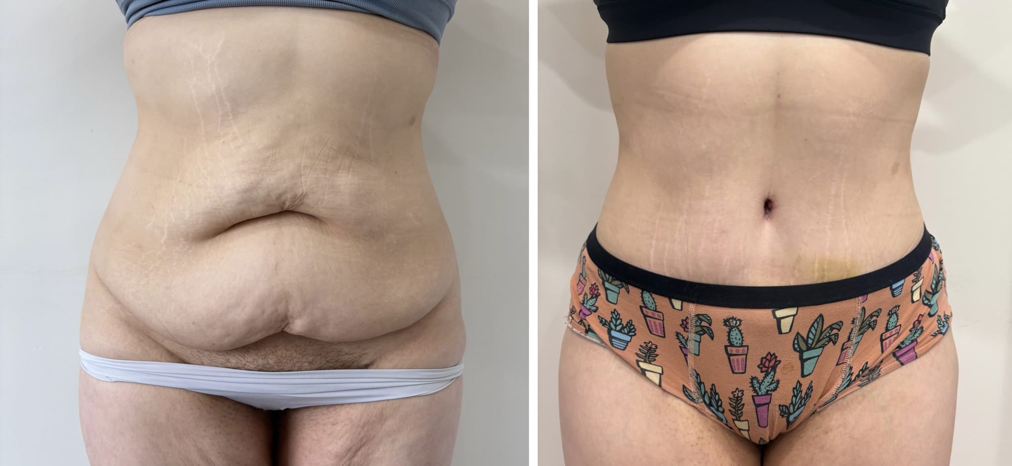 Before and after body surgery by Dr. Dana Khuthaila, plastic surgeon in New York City — patient 41