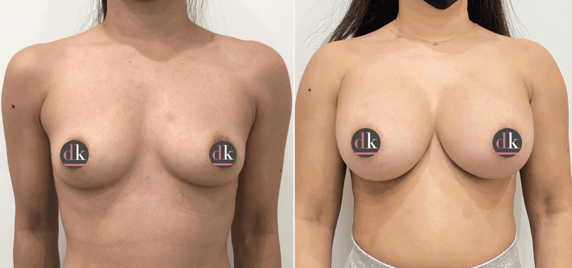 Before and after breast surgery by Dr. Dana Khuthaila, plastic surgeon in New York City — patient 25