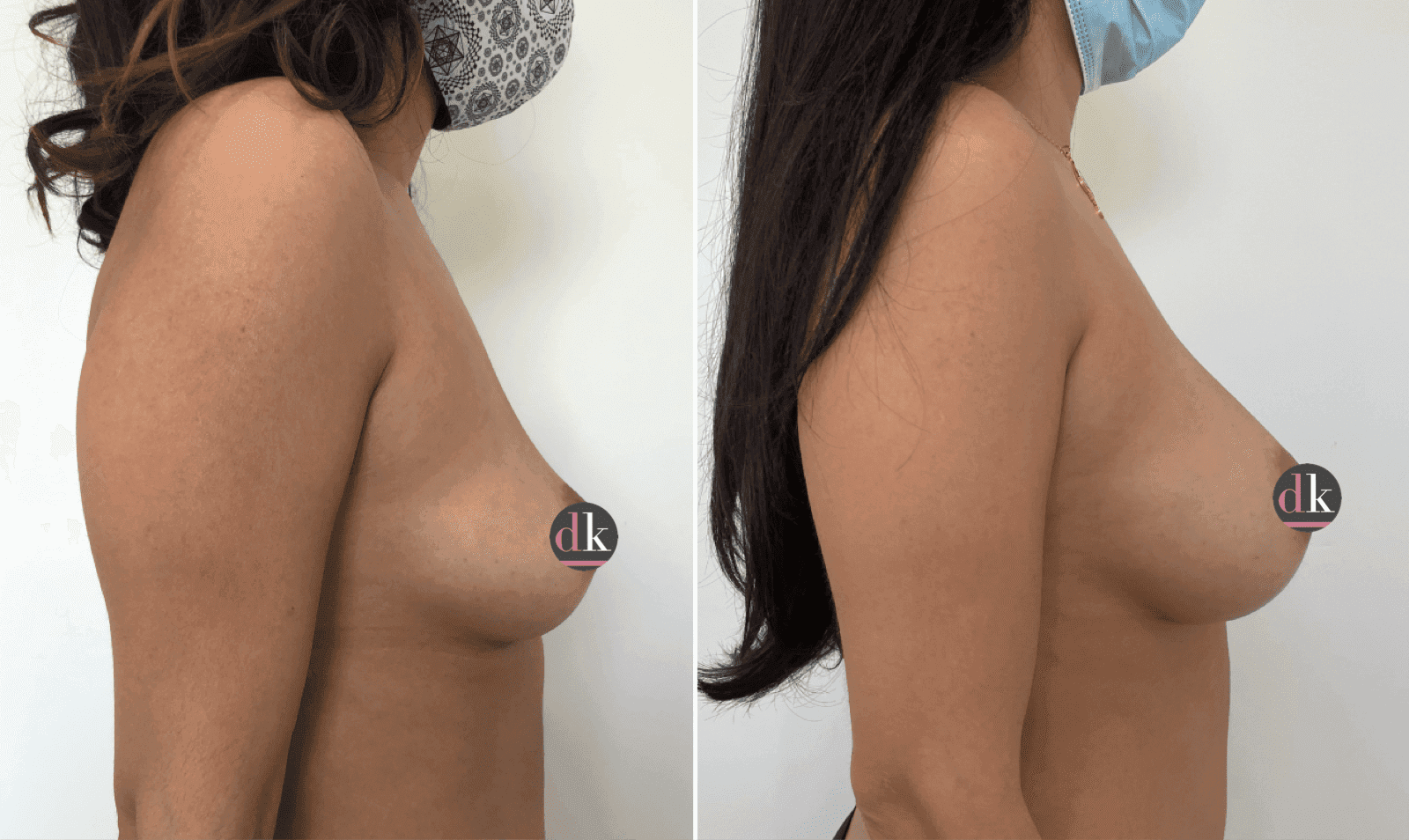 Before and after breast surgery by Dr. Dana Khuthaila, plastic surgeon in New York City — patient 43