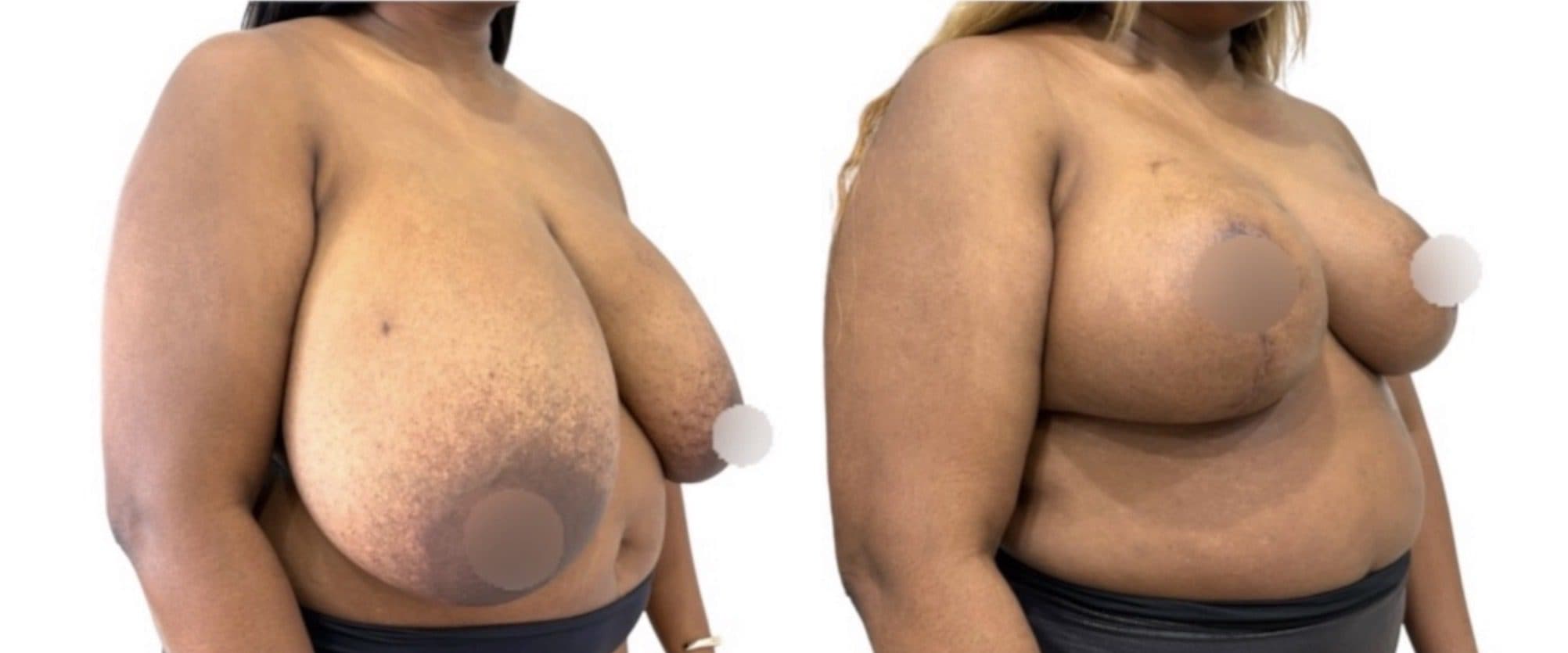 Before and after breast surgery by Dr. Dana Khuthaila, plastic surgeon in New York City — patient 2