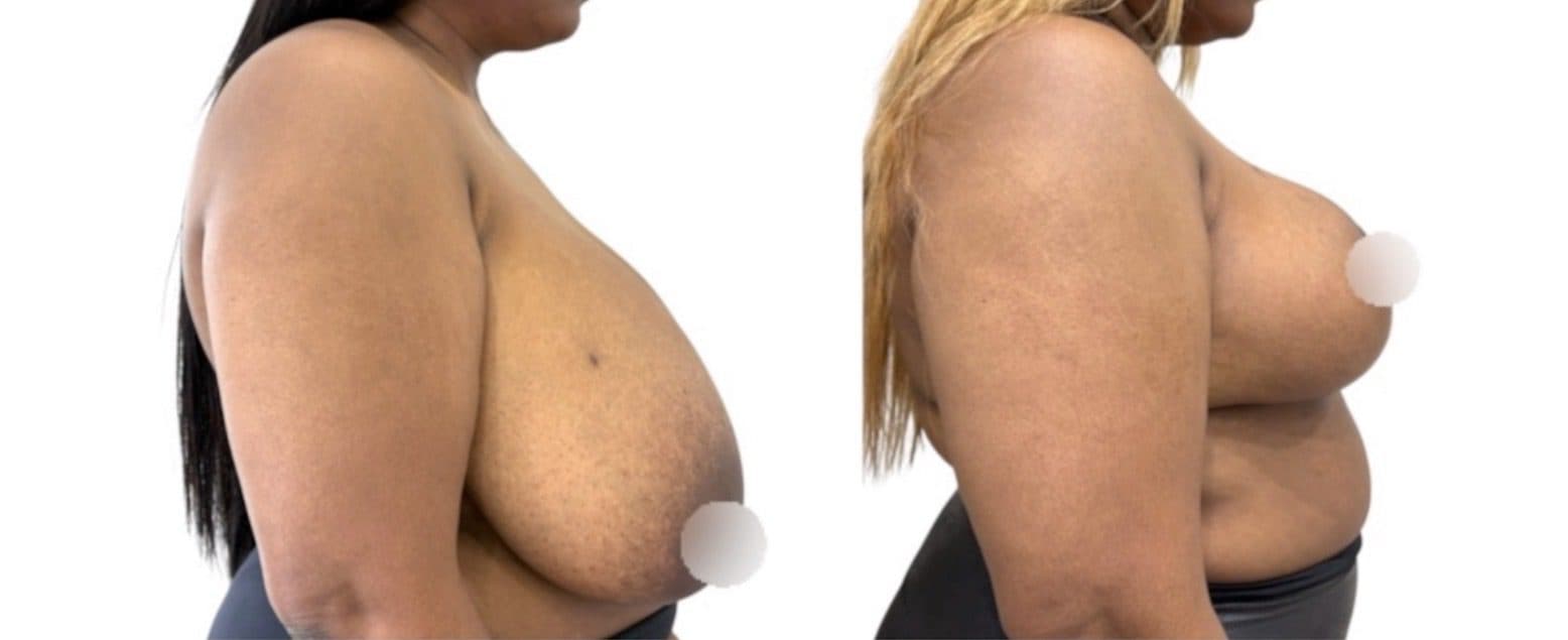 Before and after breast surgery by Dr. Dana Khuthaila, plastic surgeon in New York City — patient 1