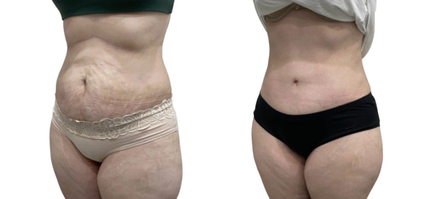 Before and after body surgery by Dr. Dana Khuthaila, plastic surgeon in New York City — patient 17
