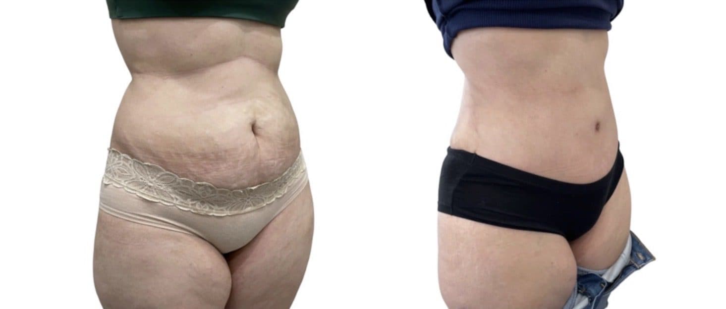 Before and after body surgery by Dr. Dana Khuthaila, plastic surgeon in New York City — patient 19