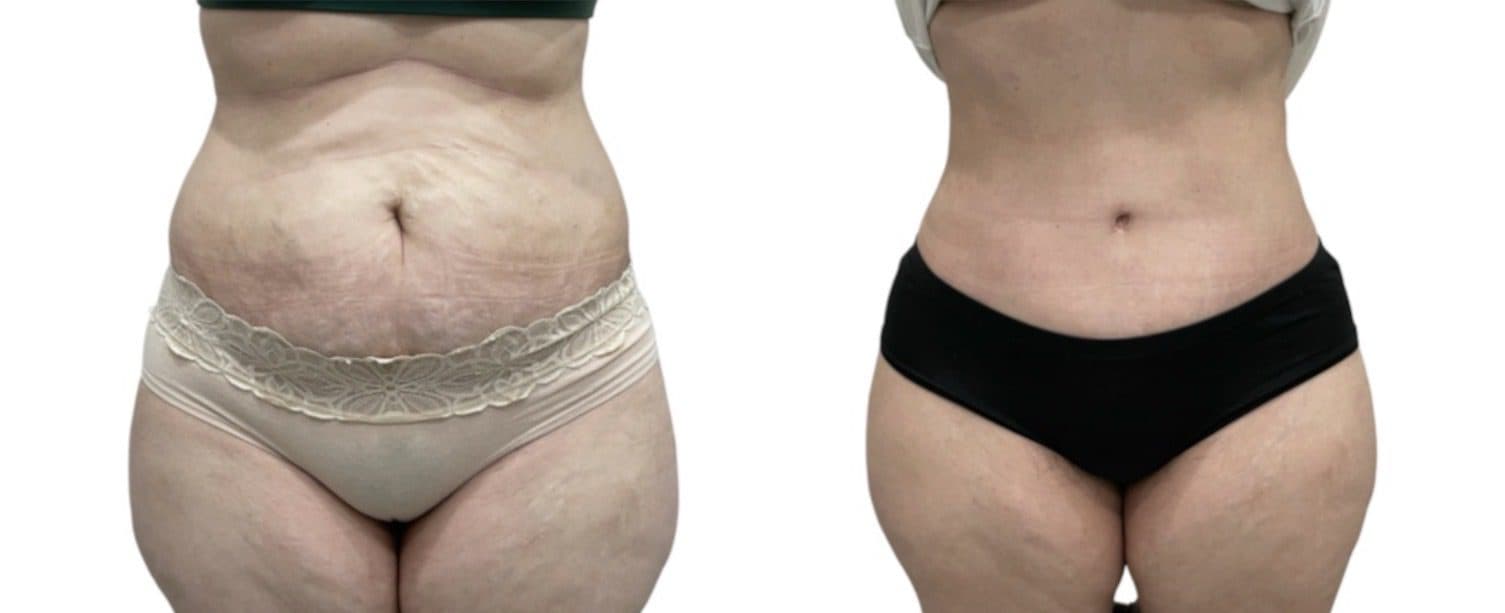 Before and after body surgery by Dr. Dana Khuthaila, plastic surgeon in New York City — patient 18