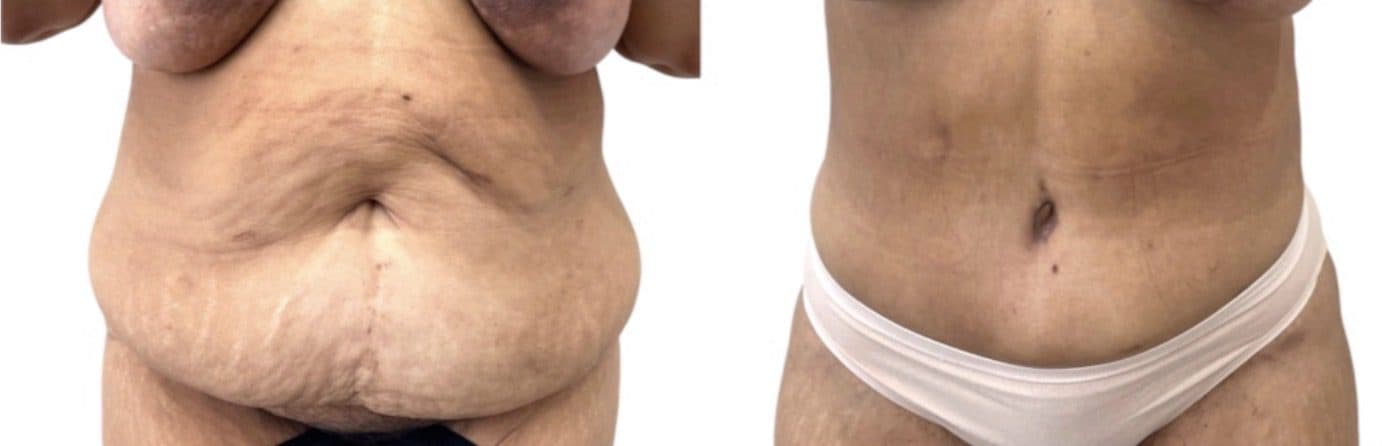 Before and after body surgery by Dr. Dana Khuthaila, plastic surgeon in New York City — patient 40