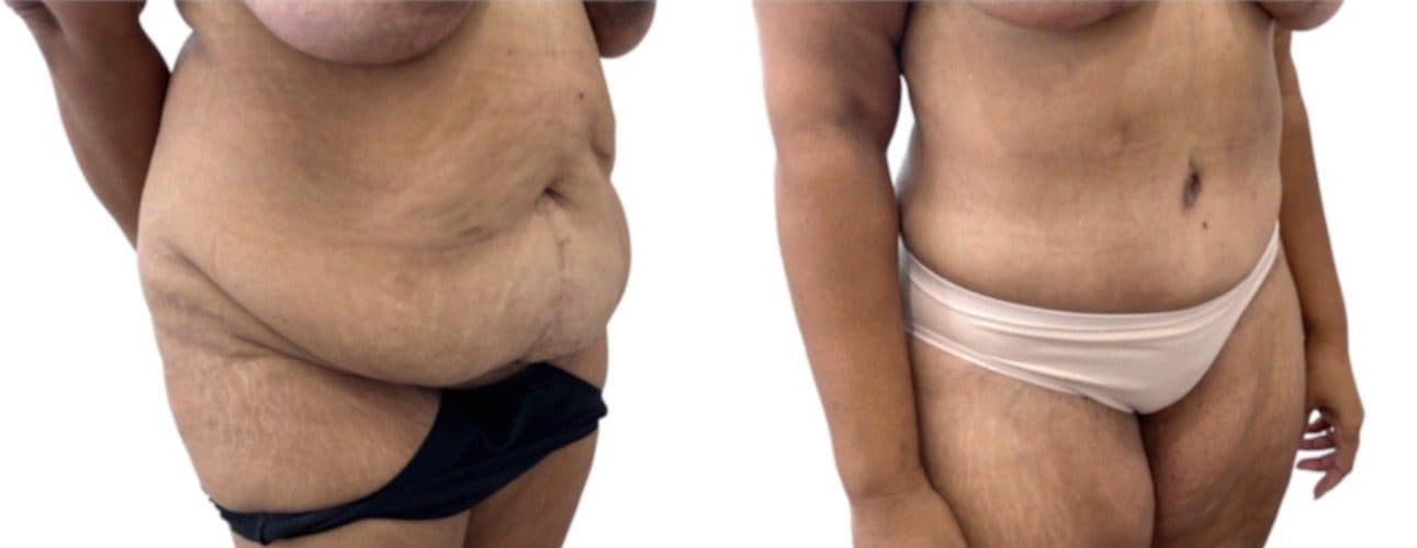 Before and after body surgery by Dr. Dana Khuthaila, plastic surgeon in New York City — patient 42