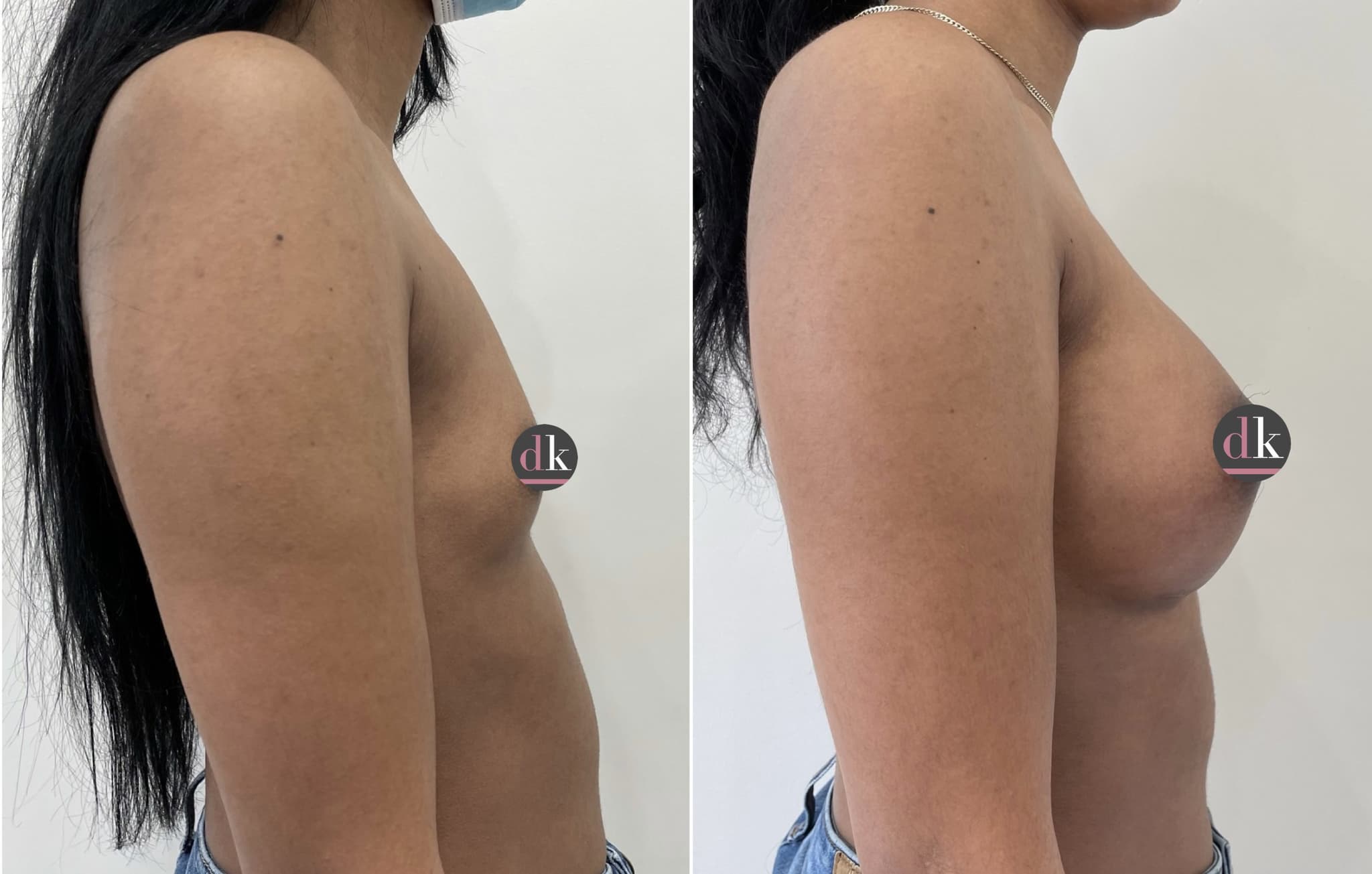 Before and after breast surgery by Dr. Dana Khuthaila, plastic surgeon in New York City — patient 38