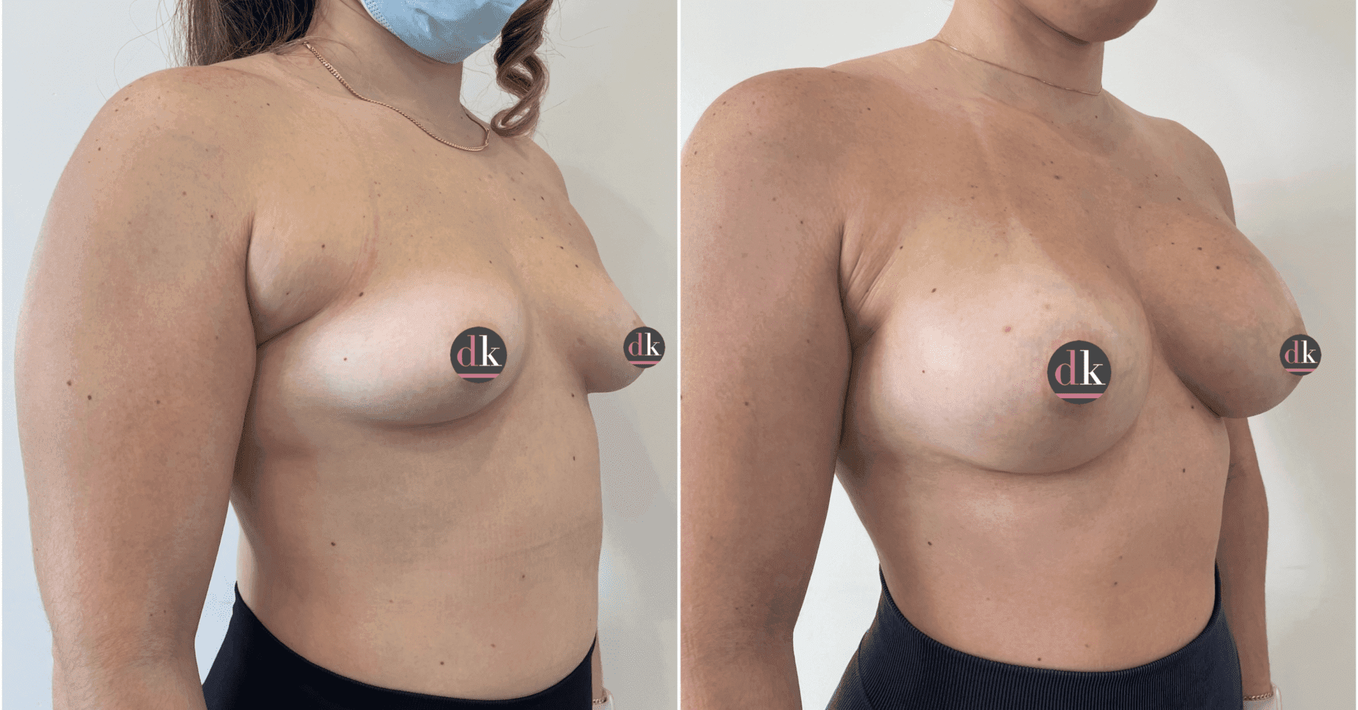Before and after breast surgery by Dr. Dana Khuthaila, plastic surgeon in New York City — patient 28