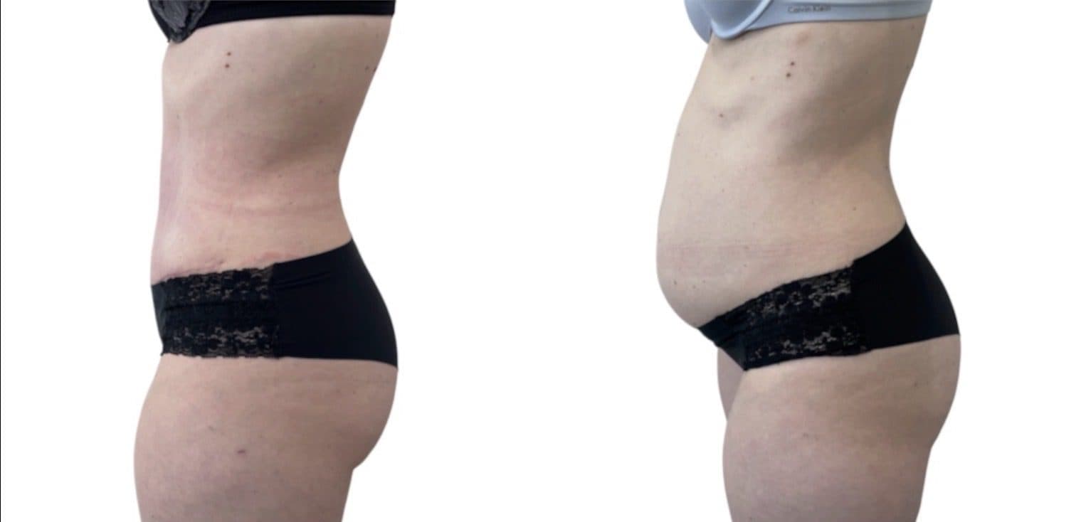 Before and after body surgery by Dr. Dana Khuthaila, plastic surgeon in New York City — patient 6
