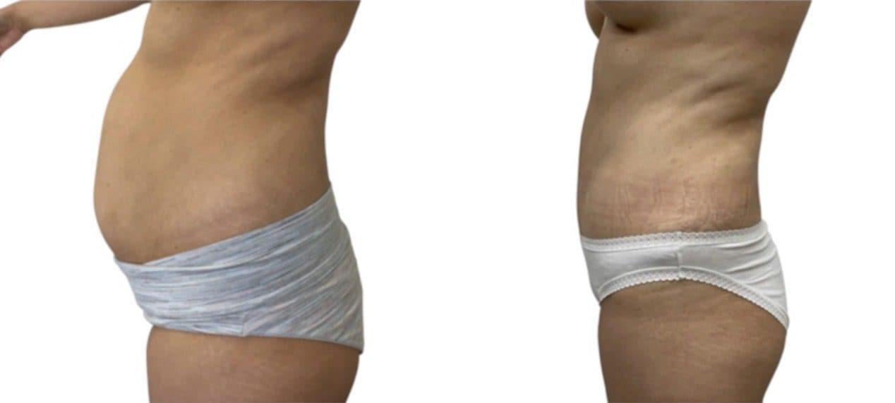 Before and after body surgery by Dr. Dana Khuthaila, plastic surgeon in New York City — patient 39
