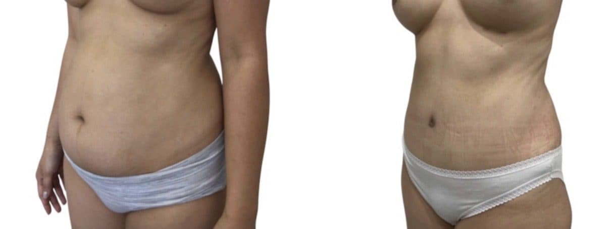 Before and after body surgery by Dr. Dana Khuthaila, plastic surgeon in New York City — patient 38