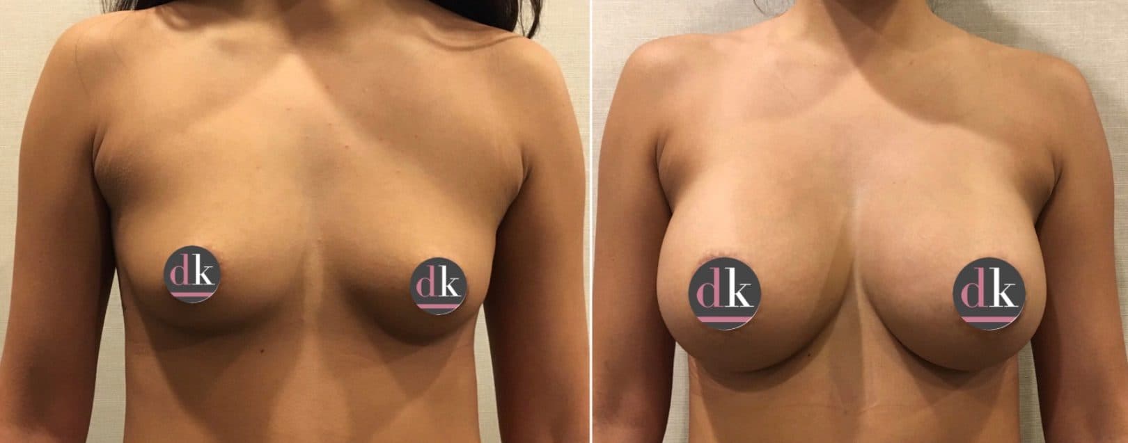 Before and after breast surgery by Dr. Dana Khuthaila, plastic surgeon in New York City — patient 37