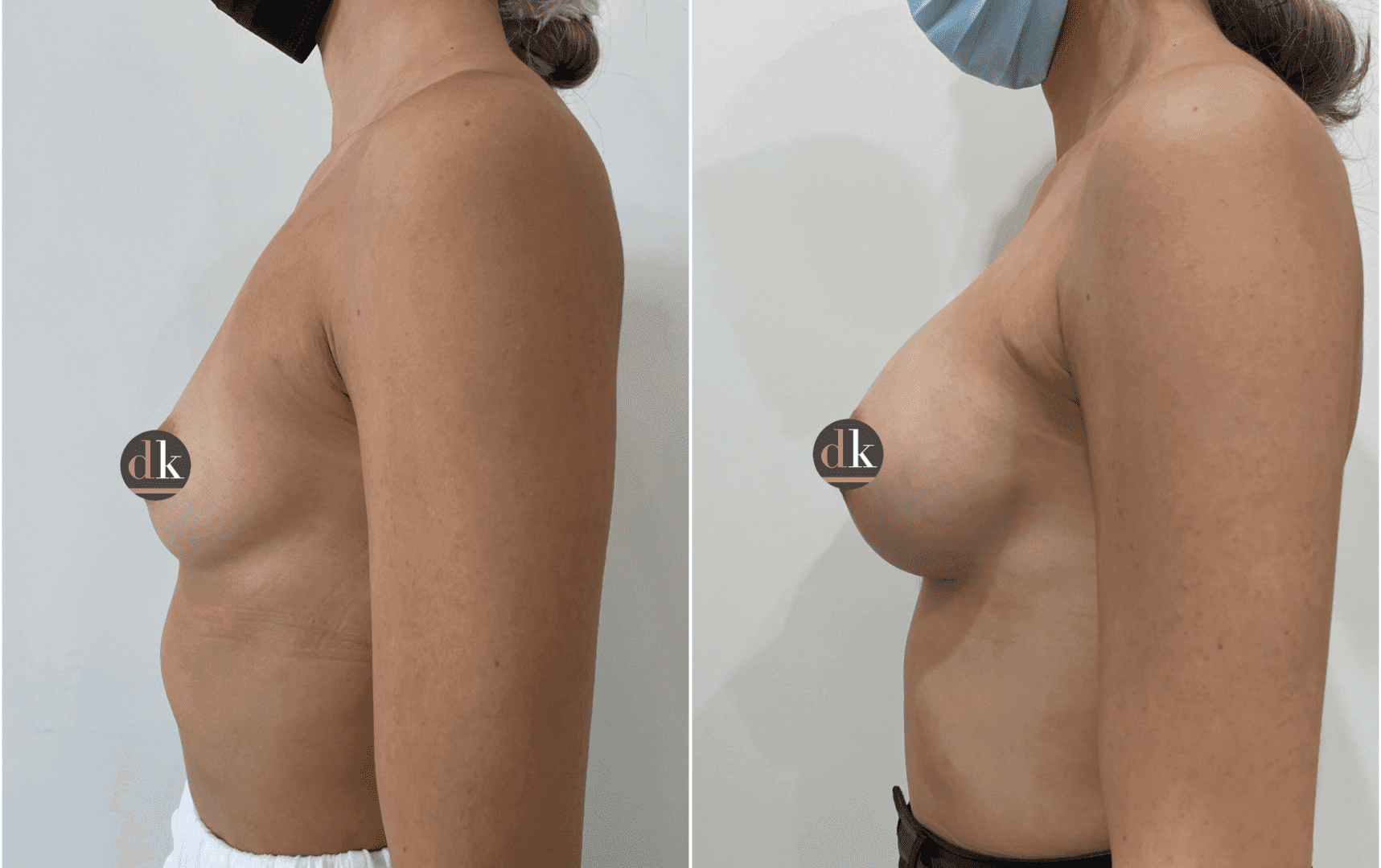 Before and after breast surgery by Dr. Dana Khuthaila, plastic surgeon in New York City — patient 41