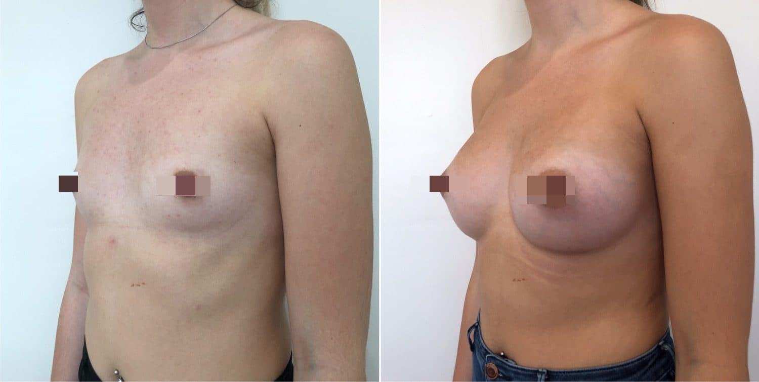 Before and after breast surgery by Dr. Dana Khuthaila, plastic surgeon in New York City — patient 67
