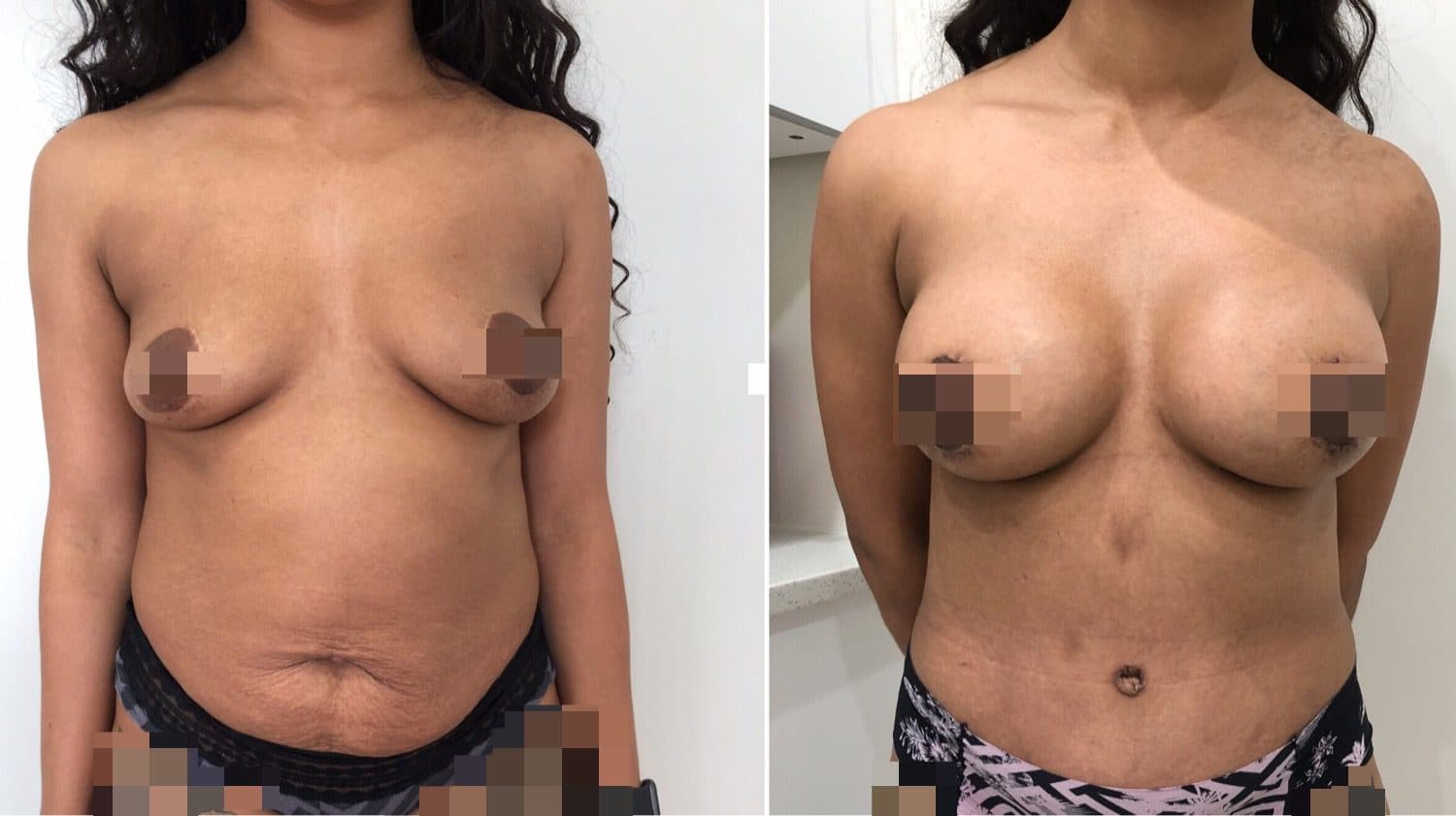 Before and after breast surgery by Dr. Dana Khuthaila, plastic surgeon in New York City — patient 66
