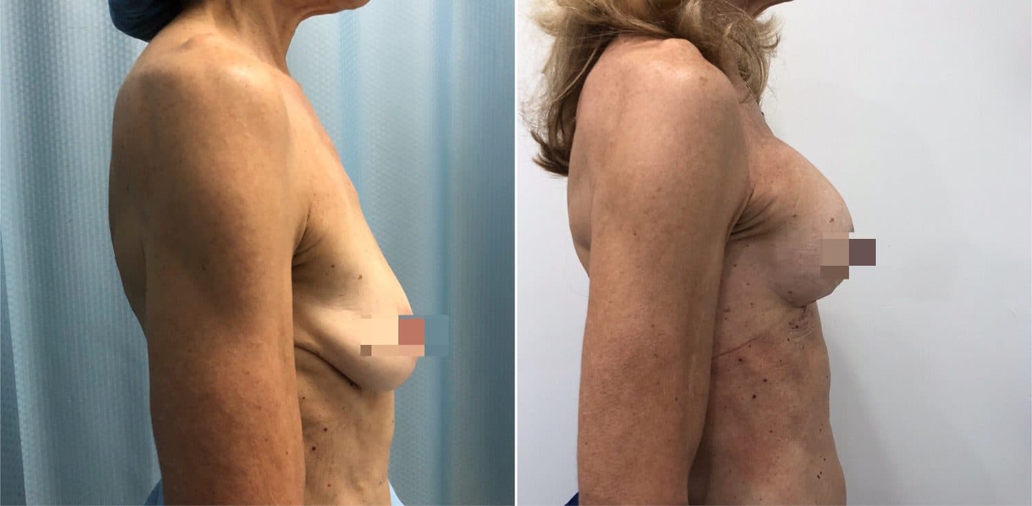 Before and after breast surgery by Dr. Dana Khuthaila, plastic surgeon in New York City — patient 64