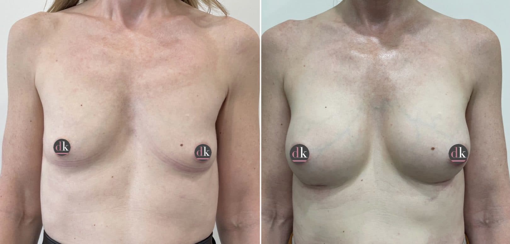 Before and after breast surgery by Dr. Dana Khuthaila, plastic surgeon in New York City — patient 31