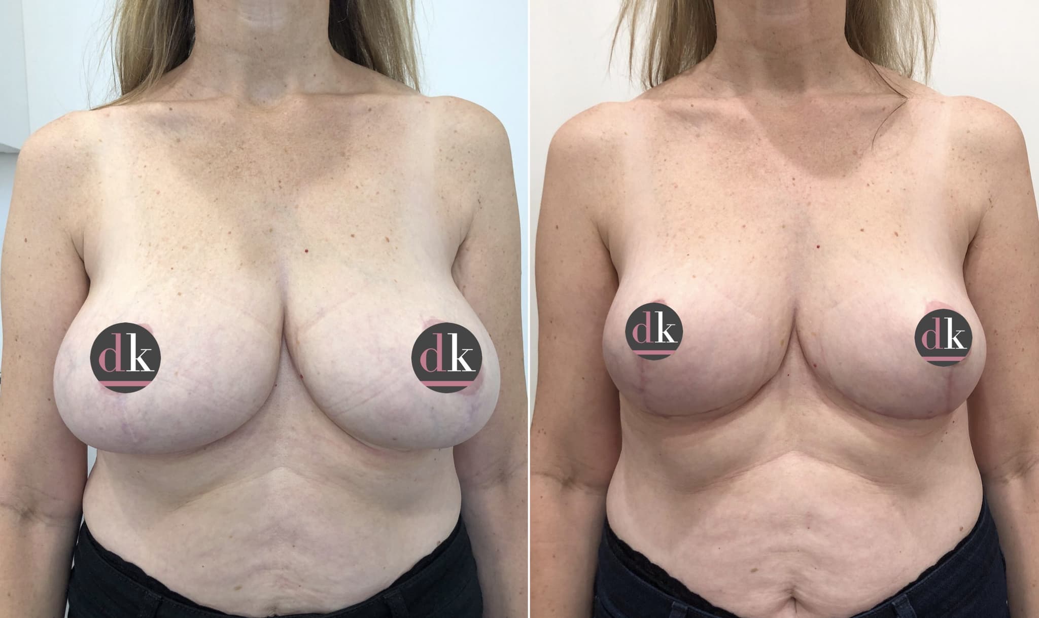 Before and after breast surgery by Dr. Dana Khuthaila, plastic surgeon in New York City — patient 57