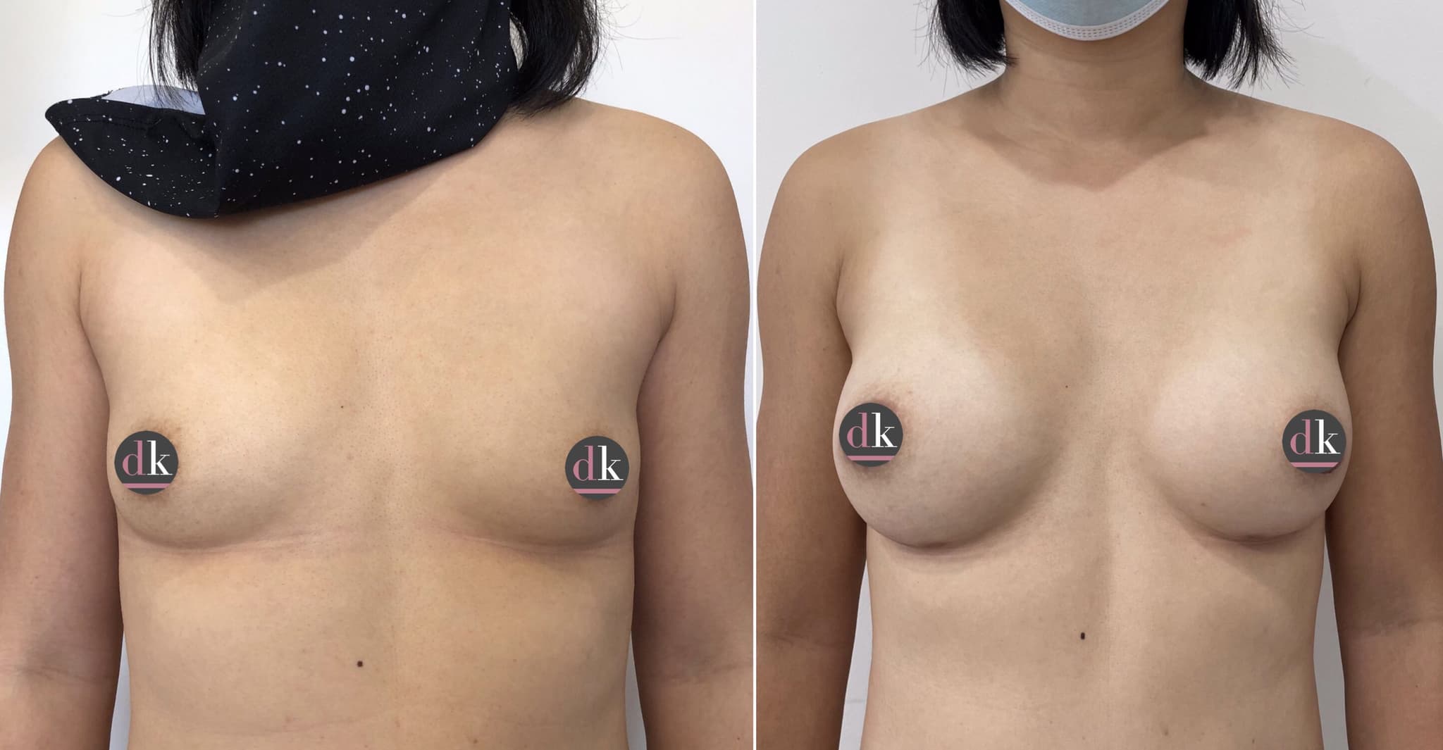 Before and after breast surgery by Dr. Dana Khuthaila, plastic surgeon in New York City — patient 65