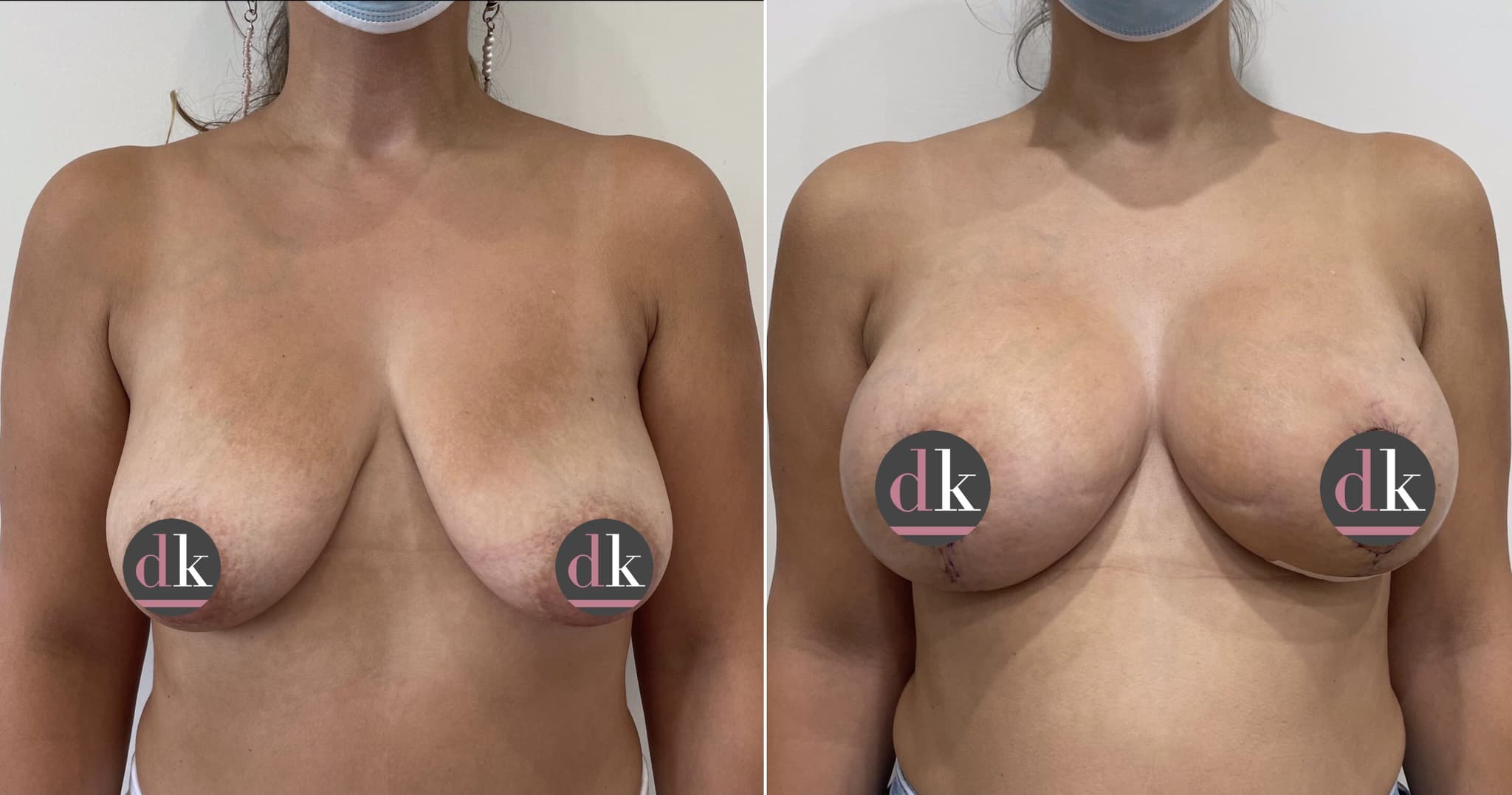 Before and after breast surgery by Dr. Dana Khuthaila, plastic surgeon in New York City — patient 22