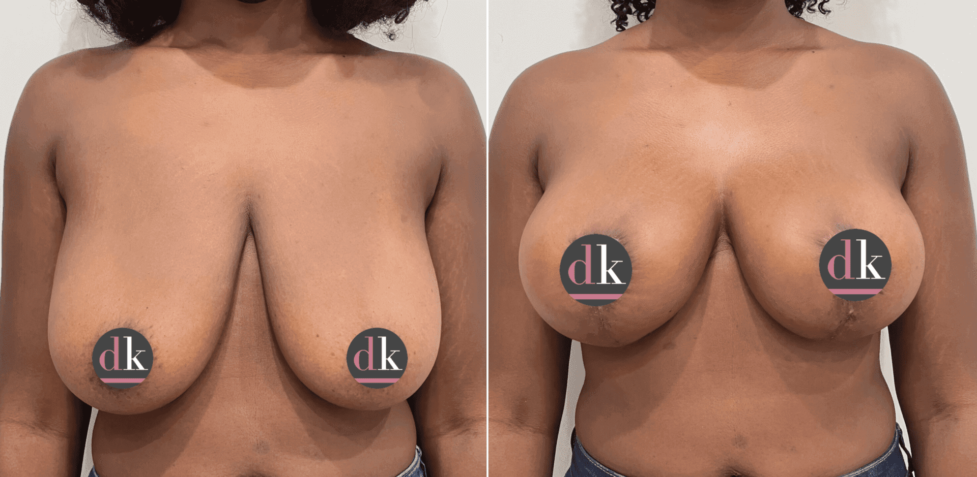 Before and after breast surgery by Dr. Dana Khuthaila, plastic surgeon in New York City — patient 7