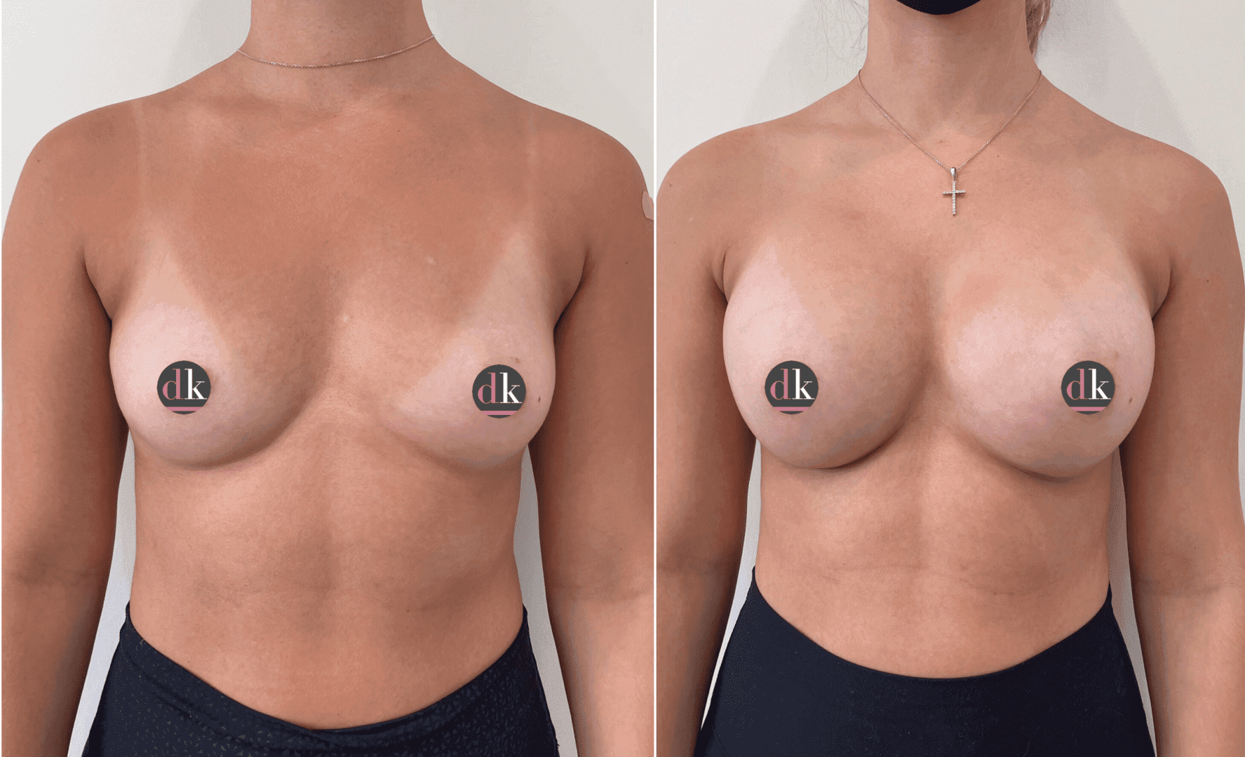 Before and after breast surgery by Dr. Dana Khuthaila, plastic surgeon in New York City — patient 62